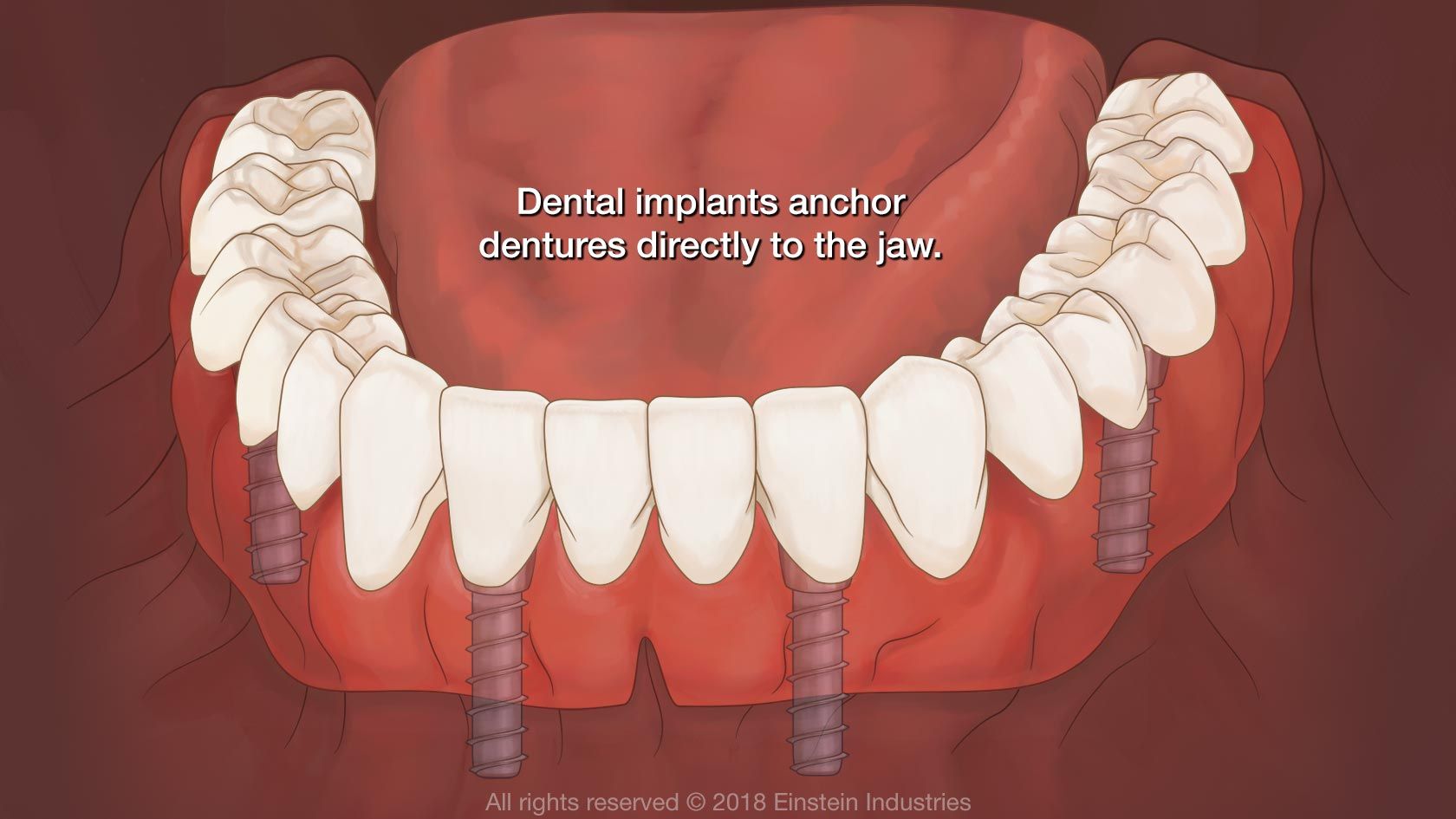 Implant-supported denture illustration